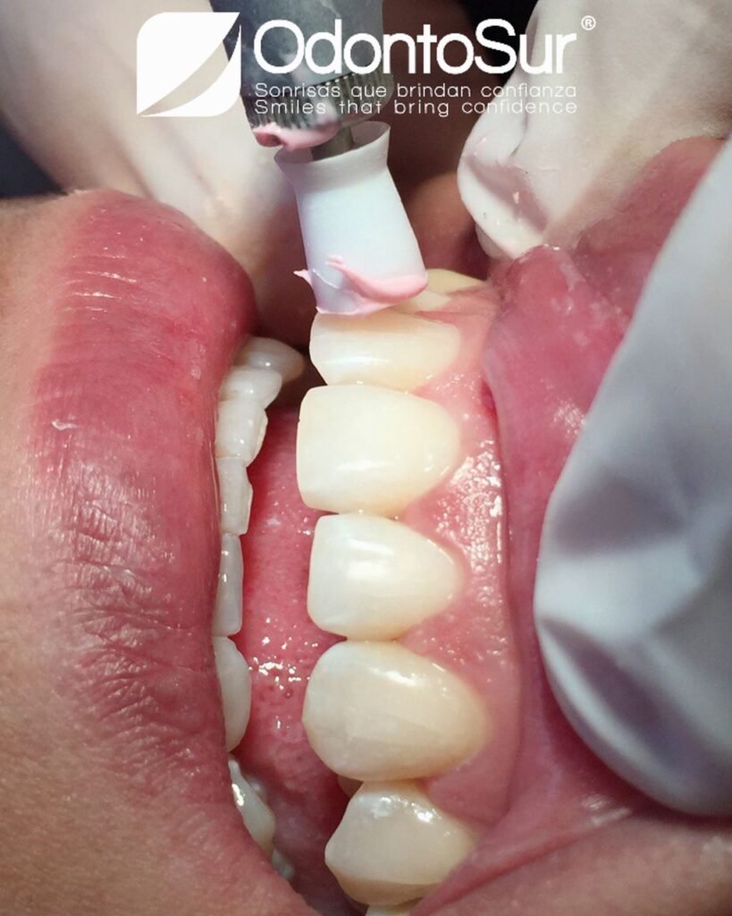 importancia de la limpieza dental o mantenimientos periodontales