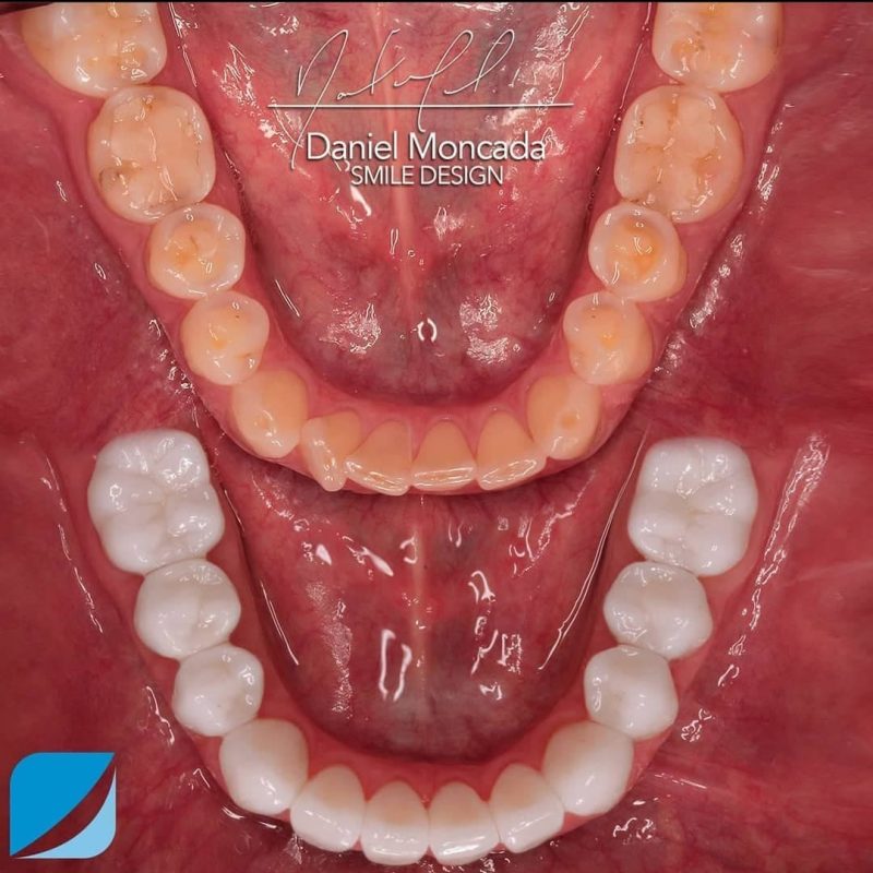 antes y despues- odotnsoru